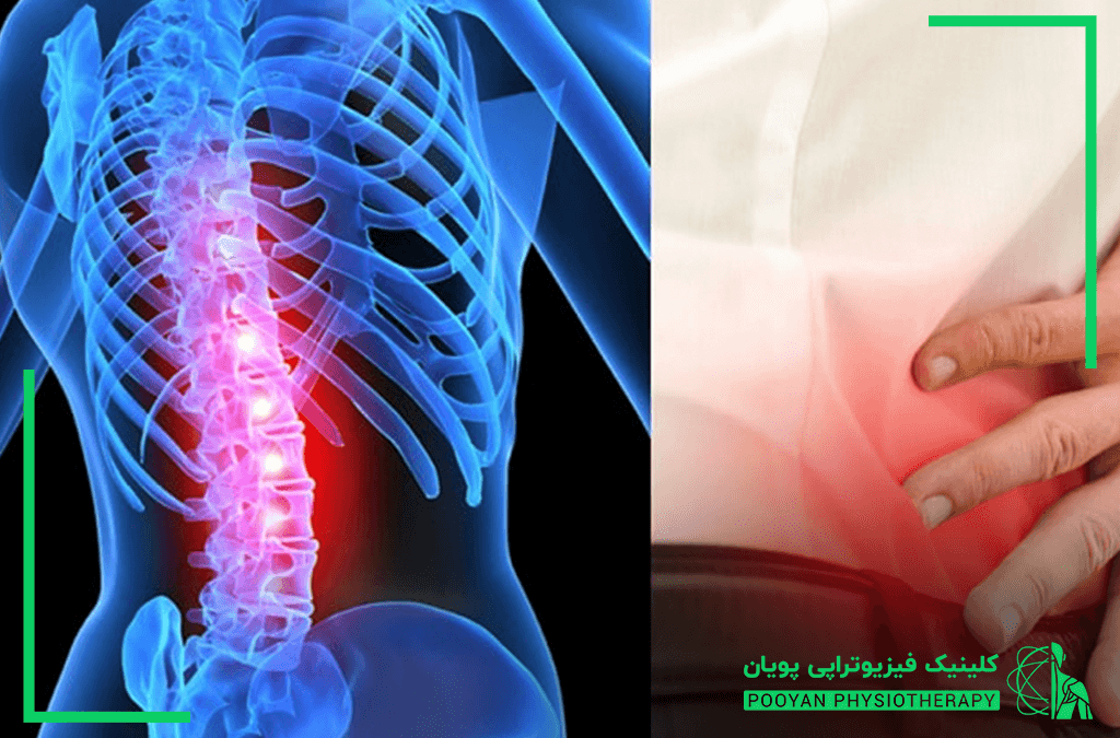 علل تنگی کانال نخاع 