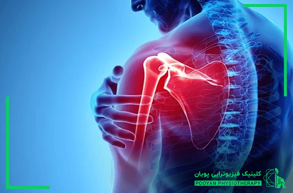 علل تنگی کانال نخاع 