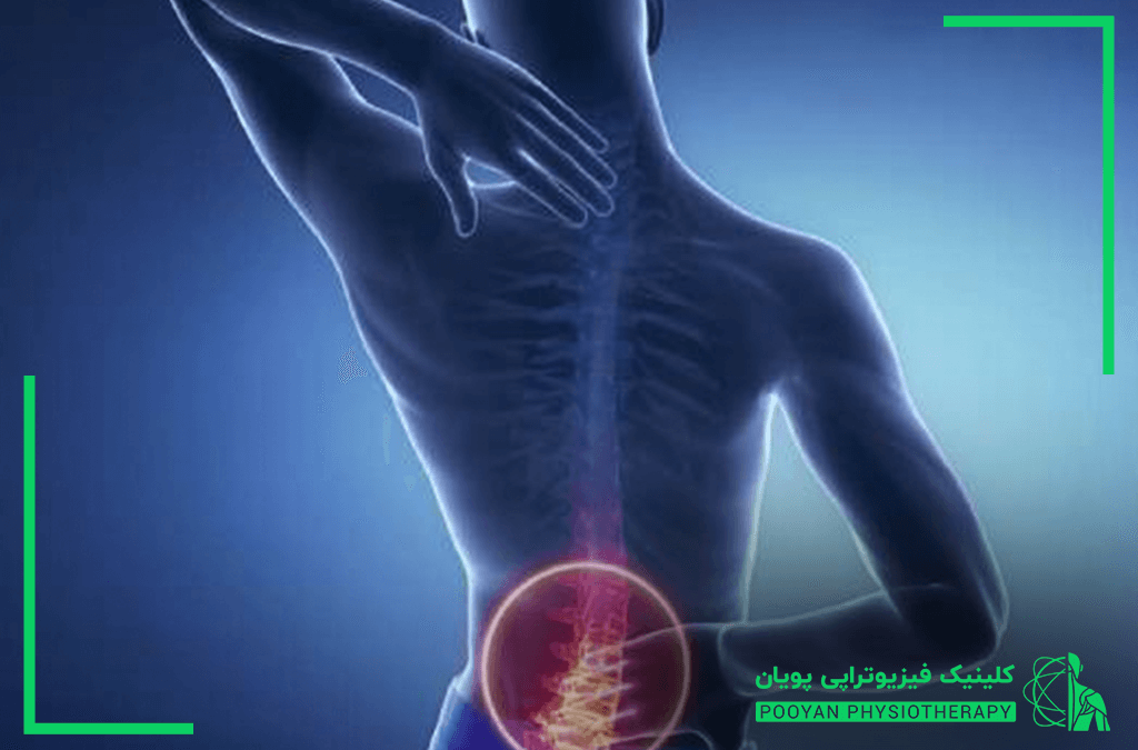 علل تنگی کانال نخاع