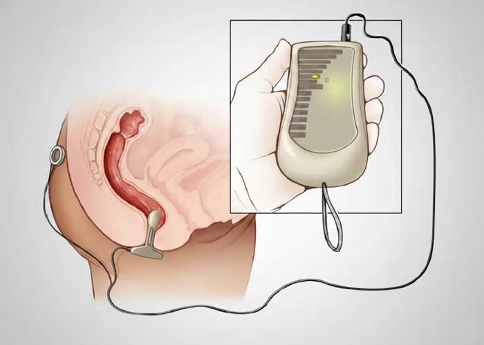فیزیوتراپی کف لگن برای چه افرادی مناسب است؟