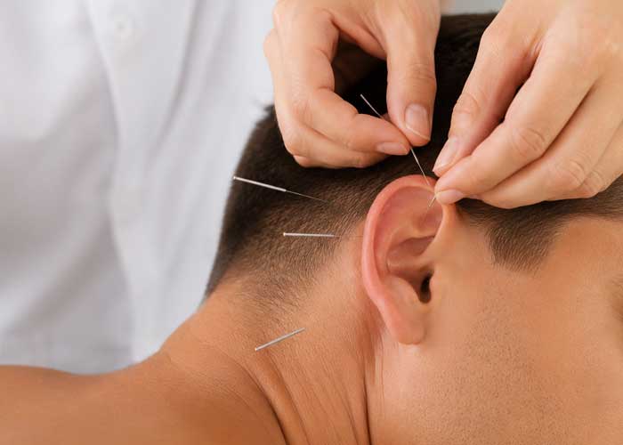 عوارض طب سوزنی و میزان درد آن | کلینیک فیزیوتراپی پویان