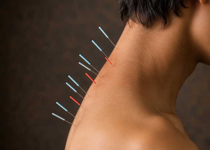 بعد از طب سوزنی چه علائمی طبیعی است؟