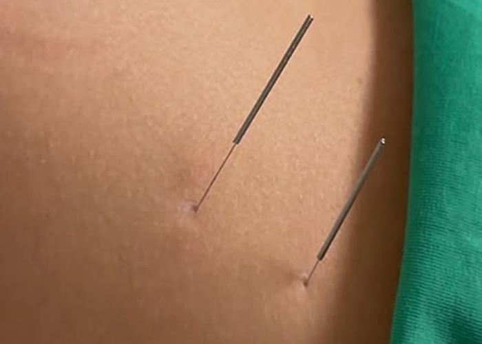 طب سوزنی در خانه | کلینیک فیزیوتراپی پویان